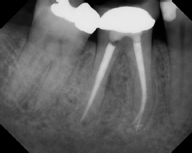 Root canal with large lesion - Meriden