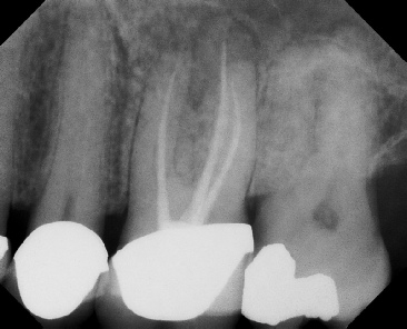 Root Canal - Access Through Crown