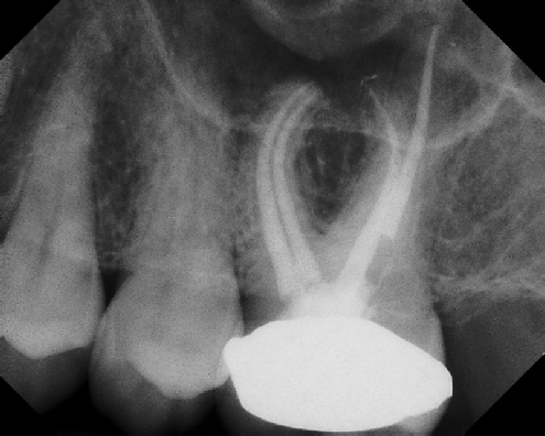 Root Canal with Calcified Canals - Meriden