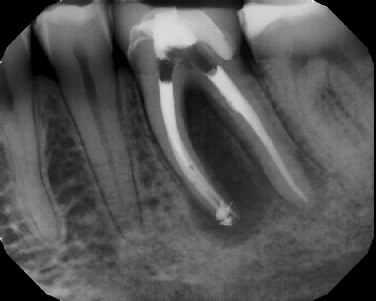 Root canal with large lesion - Stratford