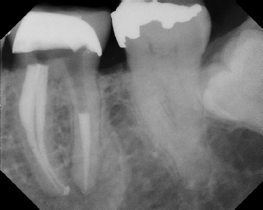 Root Canal - Broken Instrument Removal