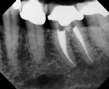 Root Canal - Access Through Crown