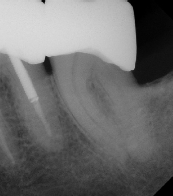 Root Canal - Access Through Crown