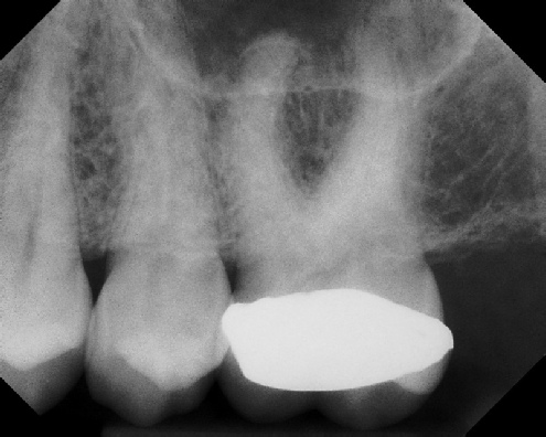 Root Canal with Calcified Canals - Meriden