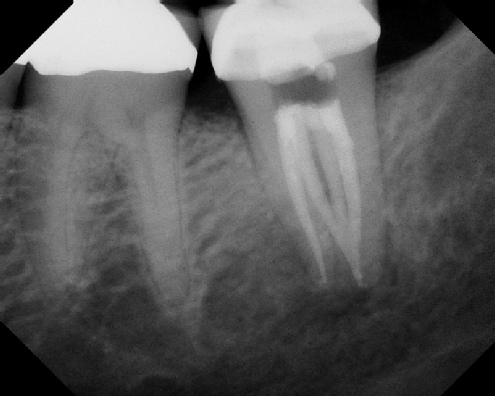 root canal anatomy - Meriden