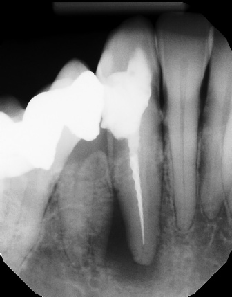 Root Canal - Broken Instrument Removal