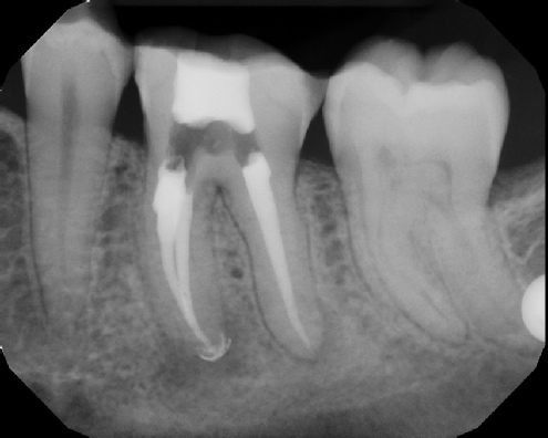 Root Canal with Calcified Canals - Meriden