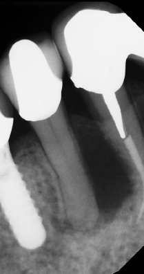 Root Canal - Access Through Crown