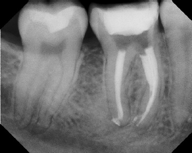 Root Canal - Broken Instrument Removal