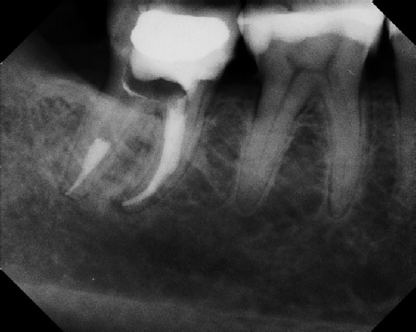 Root Canal - Broken Instrument Removal