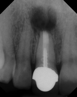 Apicoectomy - Surgical Root Canal