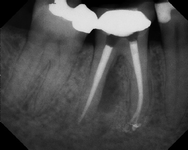 Root canal with large lesion - Meriden