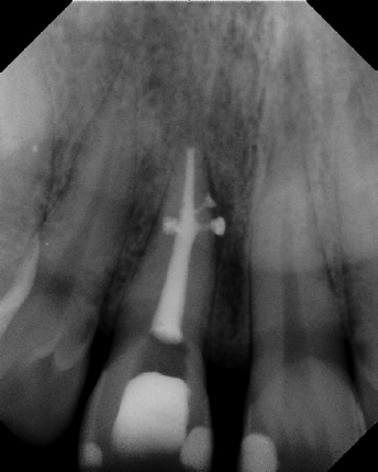 root canal anatomy - Meriden