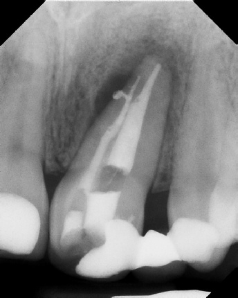 Root Canal Anatomy - Meriden