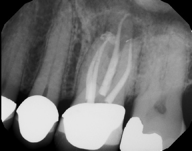 Root Canal - Access Through Crown