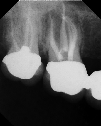 root canal anatomy - Meriden