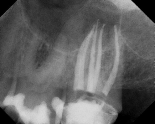 Root Canal Anatomy - Meriden