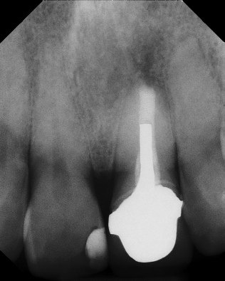 Apicoectomy - Surgical Root Canal