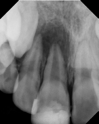 Root canal with large lesion - Meriden