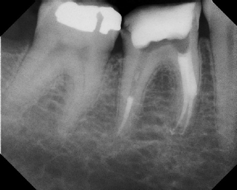 Root Canal - Broken Instrument Removal