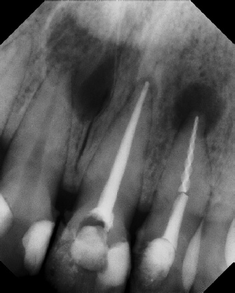 Root Canal - Broken Instrument Removal