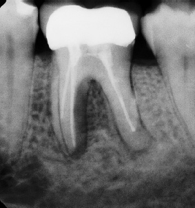 Root canal with large lesion - Stratford