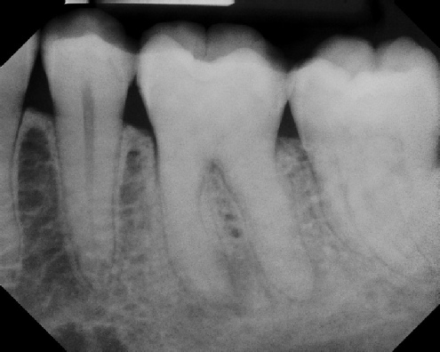 Root Canal with Calcified Canals - Meriden