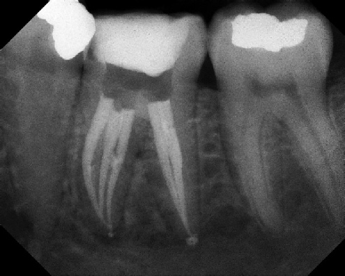 Root Canal Anatomy - Meriden