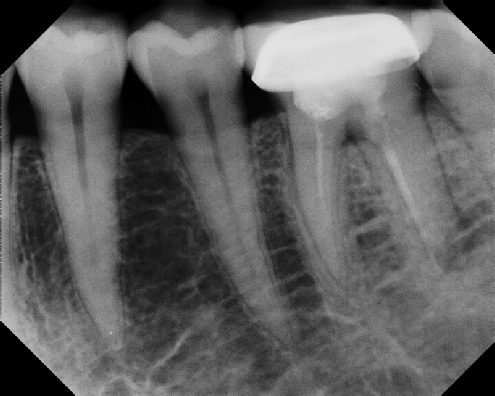 Root Canal Retreatment - Stratford