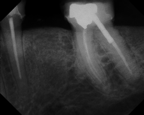 Root Canal - Broken Instrument Removal