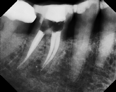 Root Canal - Broken Instrument Removal