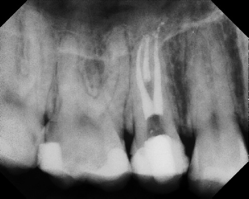 root canal anatomy - Stratford