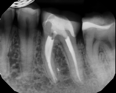 Root canal with large lesion - Stratford
