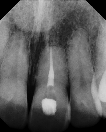 Root Canal with Calcified Canals - Meriden