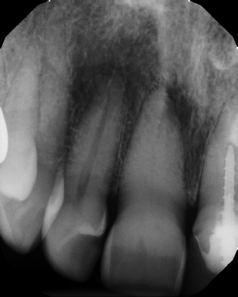 Root Canal with Calcified Canals - Stratford