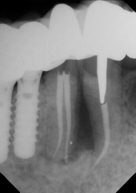 Root Canal - Access Through Crown