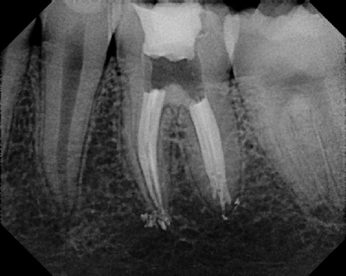 root canal anatomy - Meriden