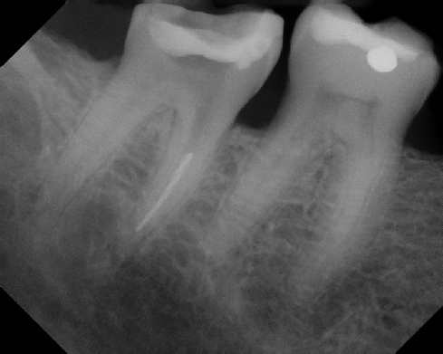 Root Canal - Broken Instrument Removal