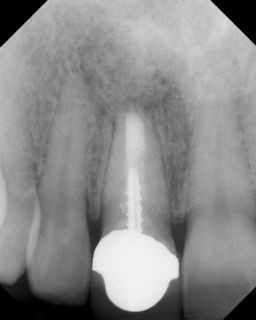 Apicoectomy - Surgical Root Canal