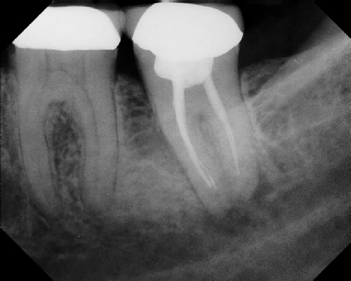 Root Canal Retreatment - Meriden