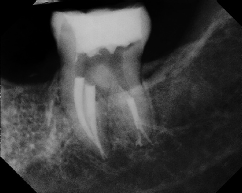 Root Canal - Broken Instrument Removal