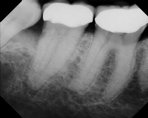 Root Canal - Access Through Crown