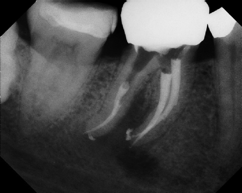 Root Canal - Broken Instrument Removal