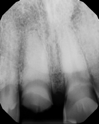 Root Canal with Calcified Canals - Meriden
