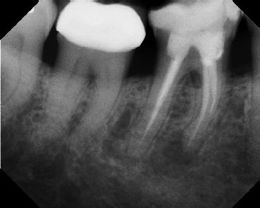 Root Canal - Broken Instrument Removal