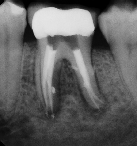 Root canal with large lesion - Stratford