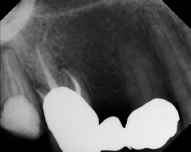 Root Canal - Broken Instrument Removal